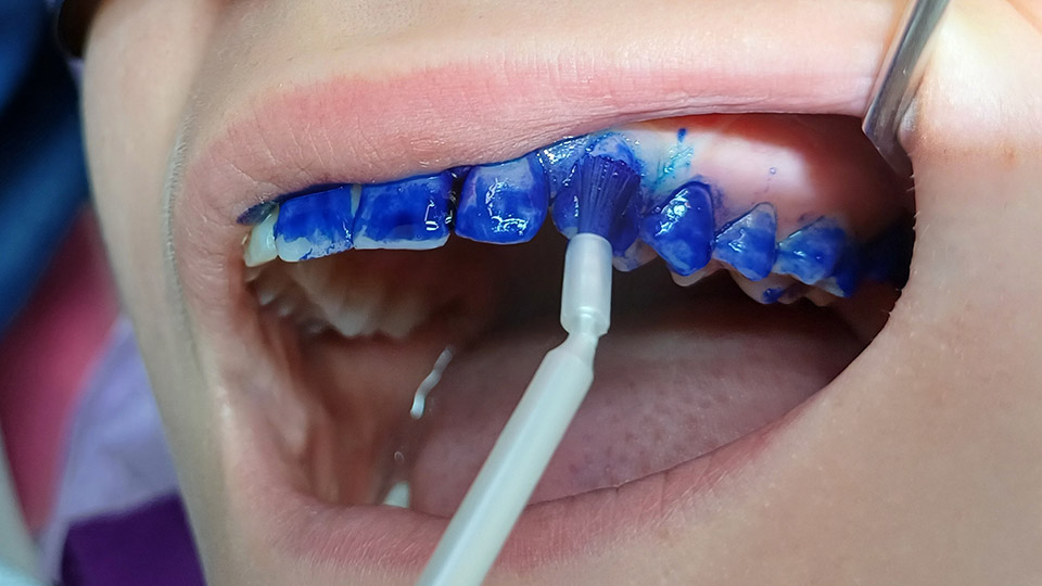 Plakkivarjays suuhygienisti jenni luukkanen